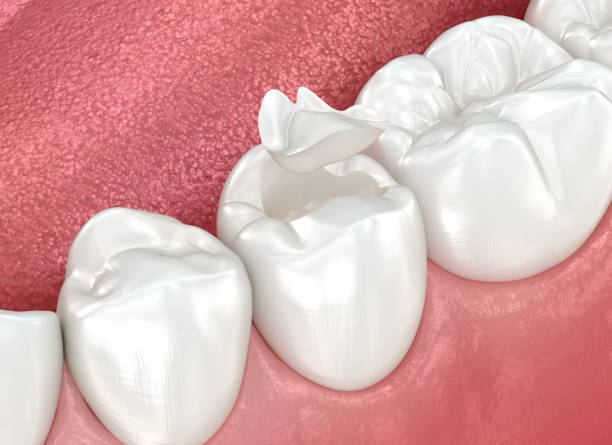 Best Dental Inlays and Onlays  in Fort Knox, KY